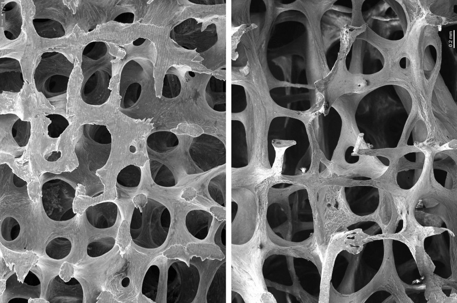 Osteoporosis and Metabolic Bone disease | (archive) Division of ...